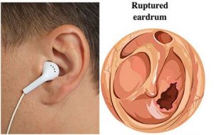 eardrum1-min